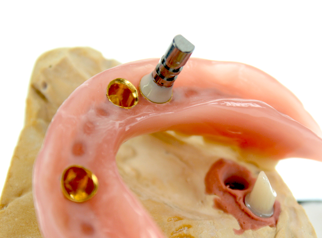 Die auf dem Zahn/Implantat angebrachte Krone besteht dabei aus zwei Teilen:<br>Einer Zirkonkrone und einen hauchdünnen Goldkappe.